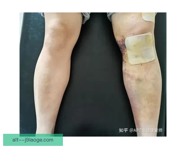科尔十字韧带断裂后的艰难康复之路全纪录